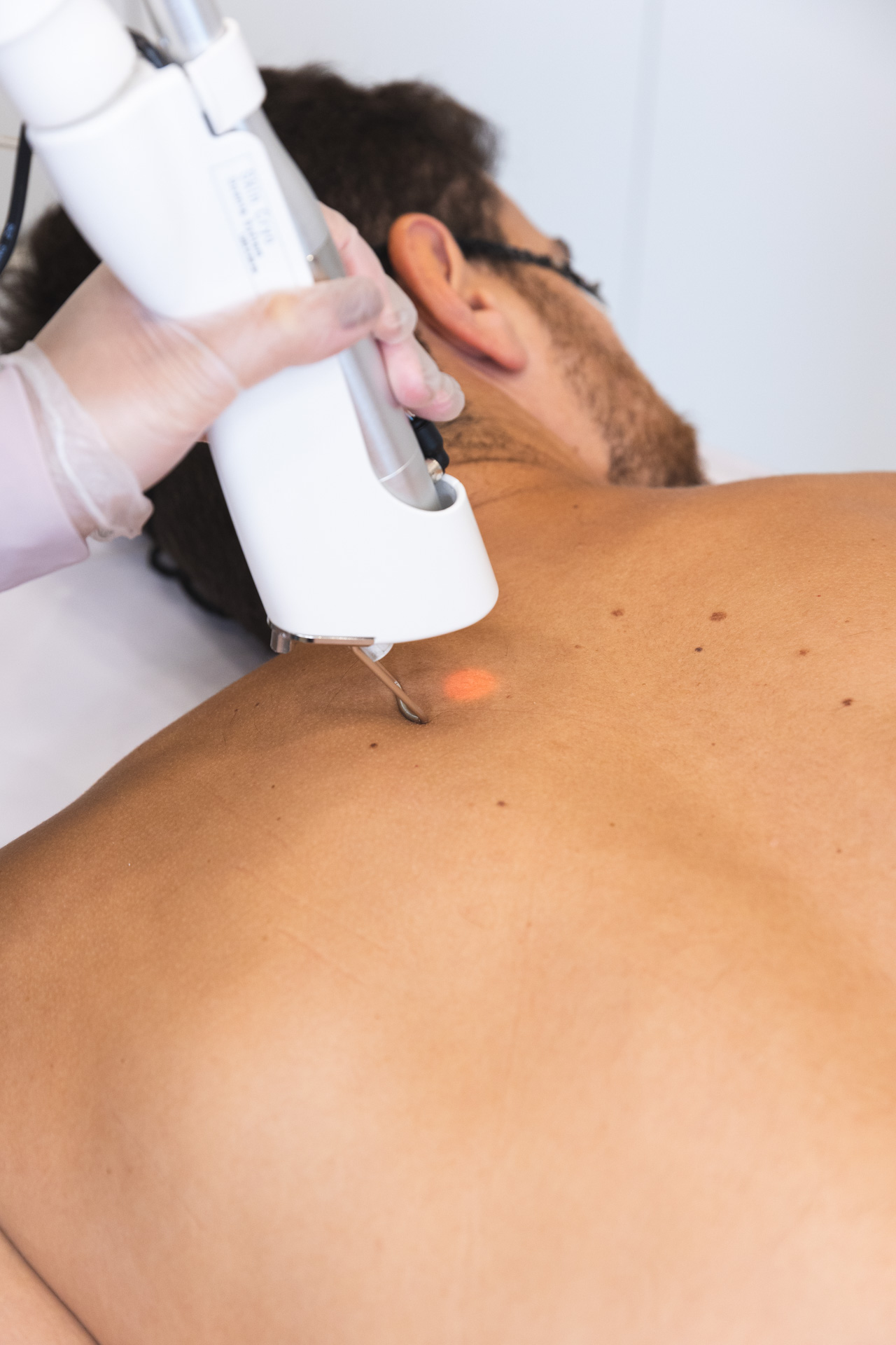 Depilação a laser de costas